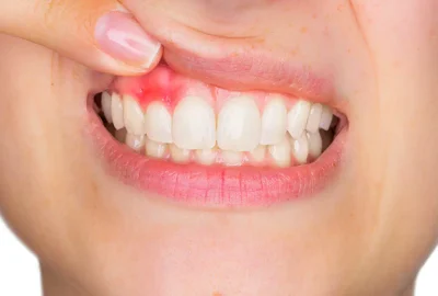 Fix-Heal-Treat-Abscessed-Tooth-Northern-Kentucky-Burlington.webp