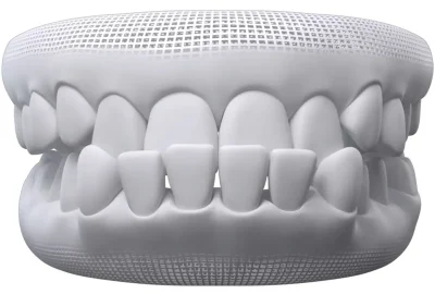 Underbite-invisalign-DENTIST-NEAR-YOU-Webp.webp
